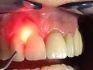 laser gum depigmentation