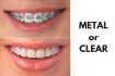 orthodontic treatment