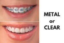 orthodontic treatment